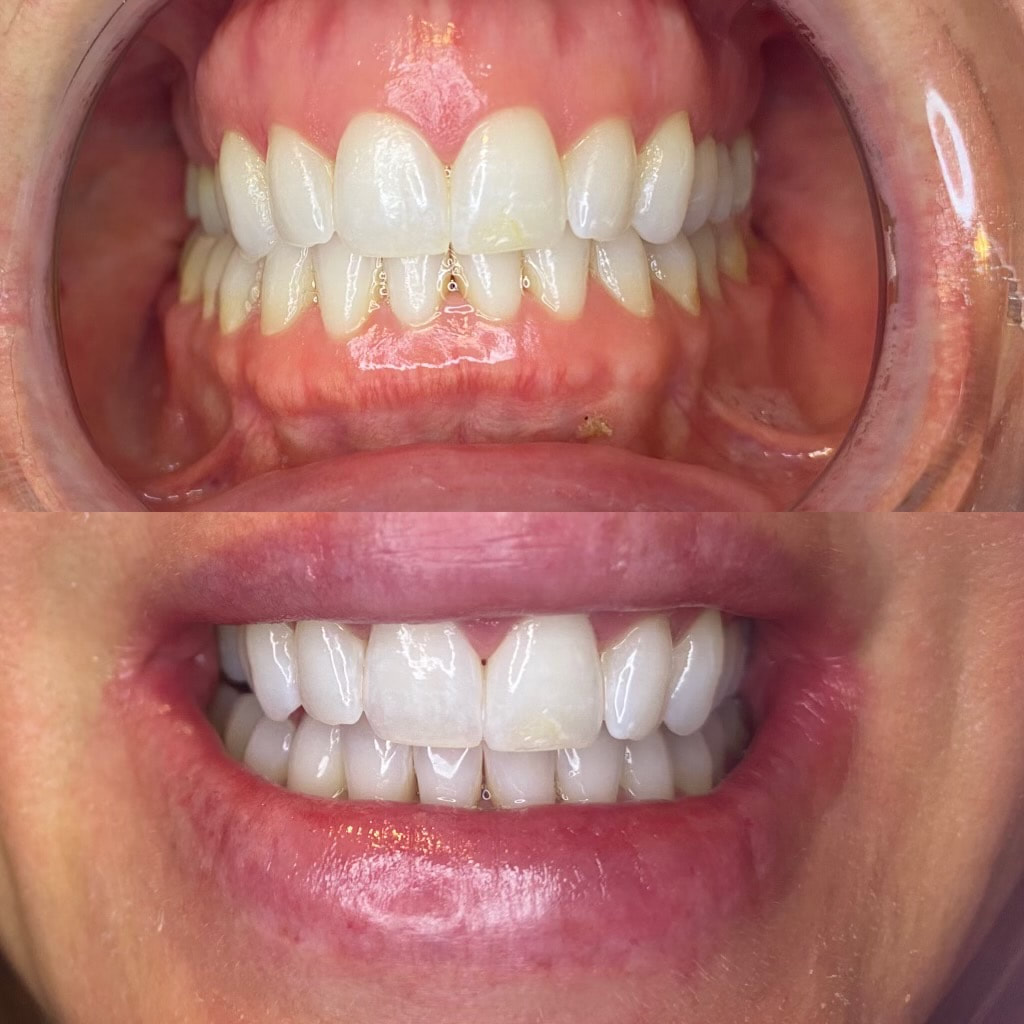 Teeth Whitening Ogden