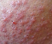Treatment of Reddish Bumps after Bikini Waxing - OGDEN LASH AND WAX